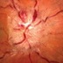 A swollen optic nerve.